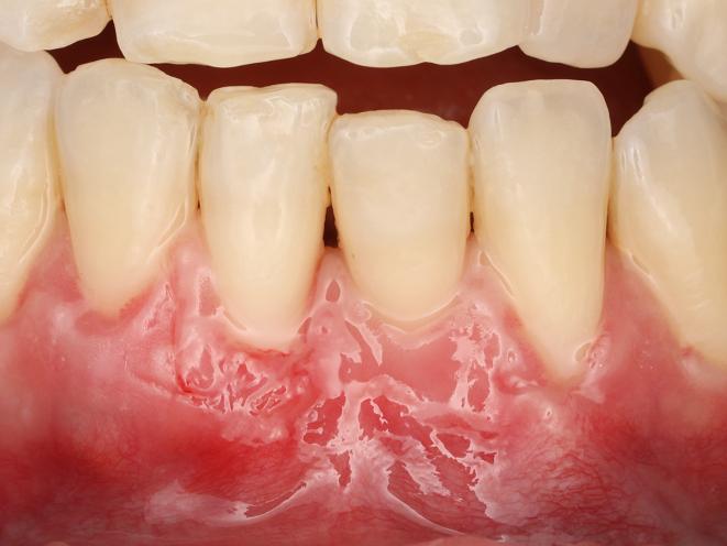  cirurgia mucogengival: após 10 dias