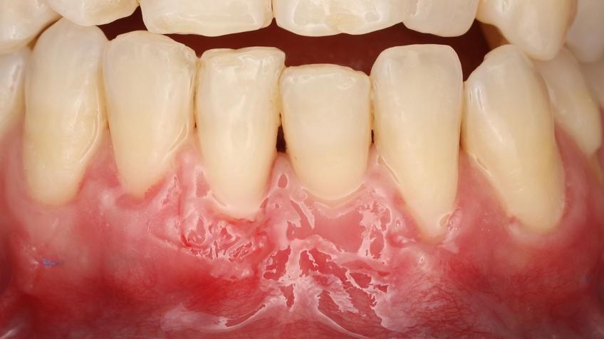  cirurgia mucogengival: após 10 dias