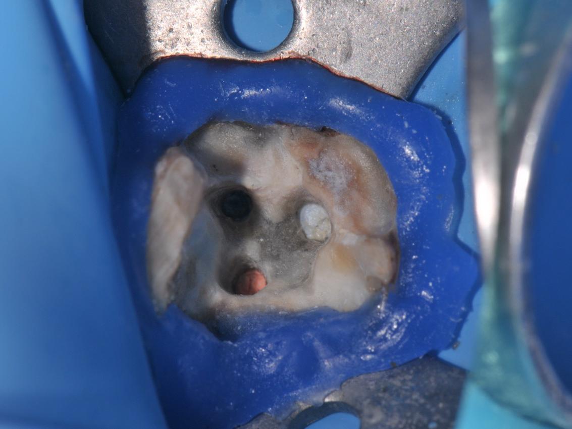 Pre-operative image showing that it is impossible to visualize the broken fragment from naked eye perspective