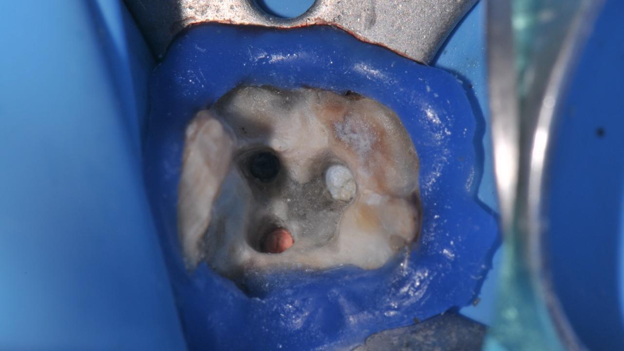 Pre-operative image showing that it is impossible to visualize the broken fragment from naked eye perspective