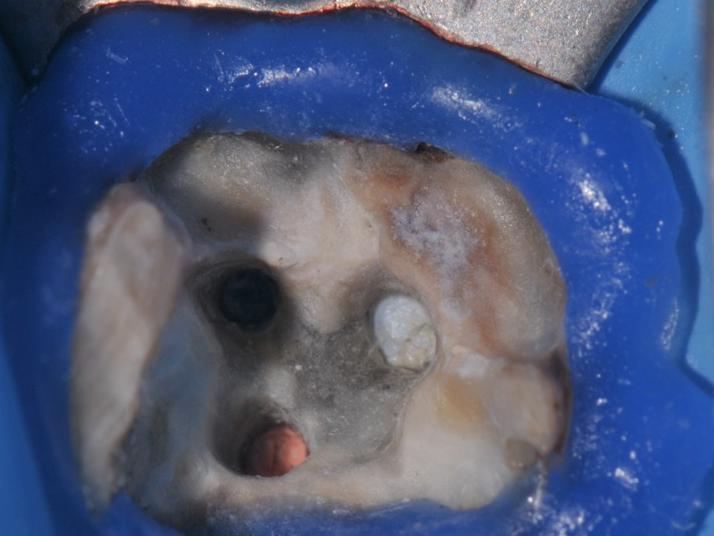 Rimozione di strumenti endodontici
