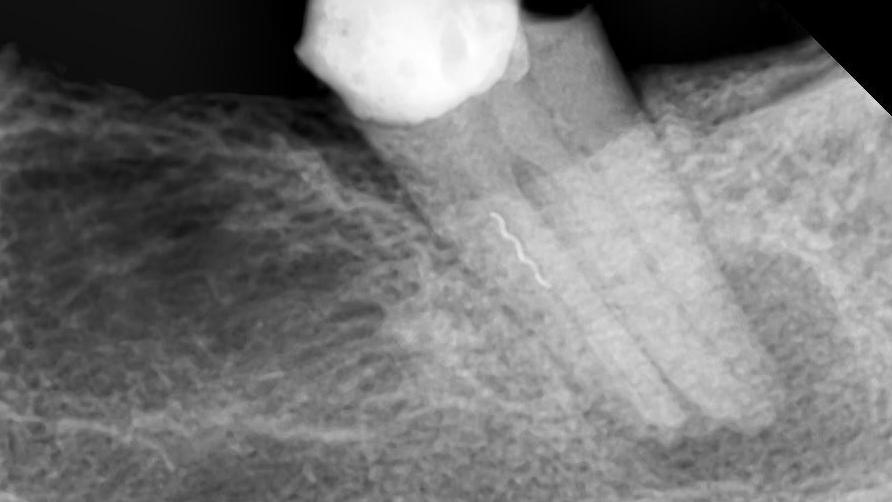 Pre-operative radiograph