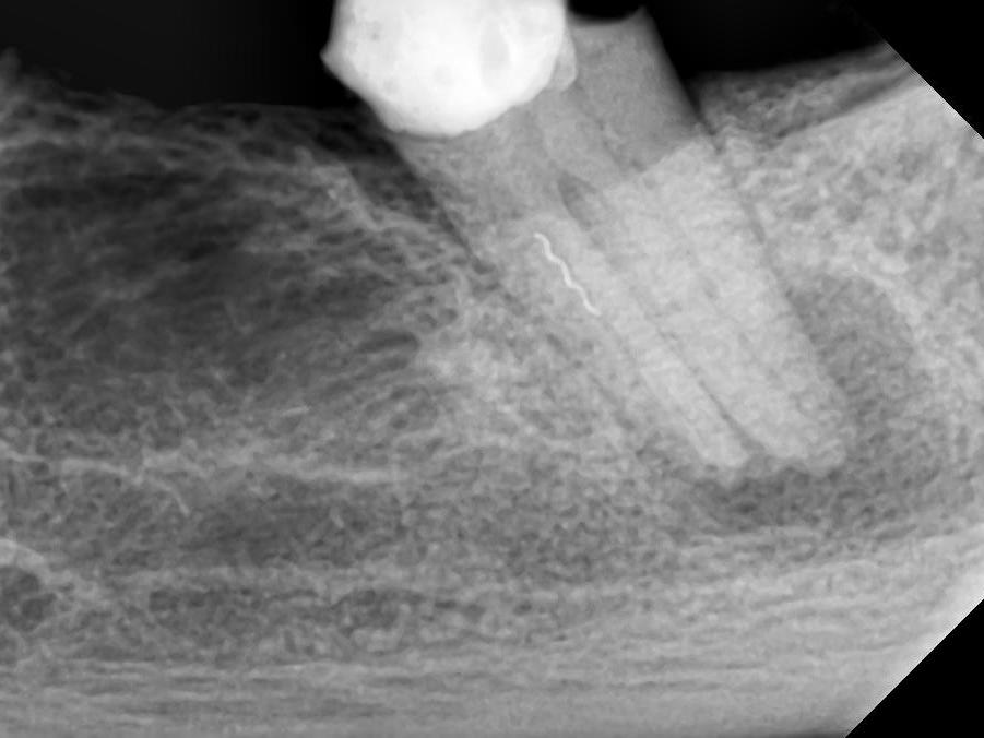 Pre-operative radiograph