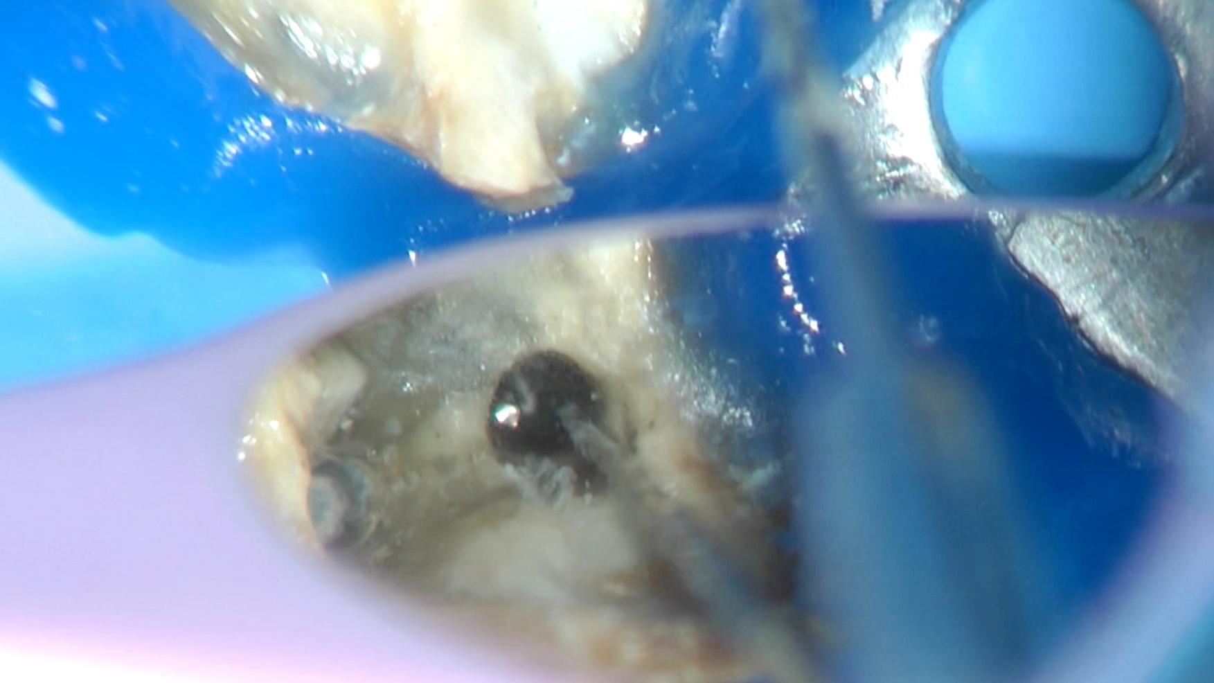 Intra-operative image of the visualization of the broken fragment under the microscope view