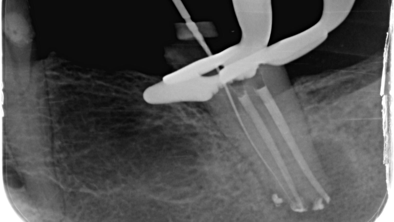 Intra-operative radiograph after broken file removal