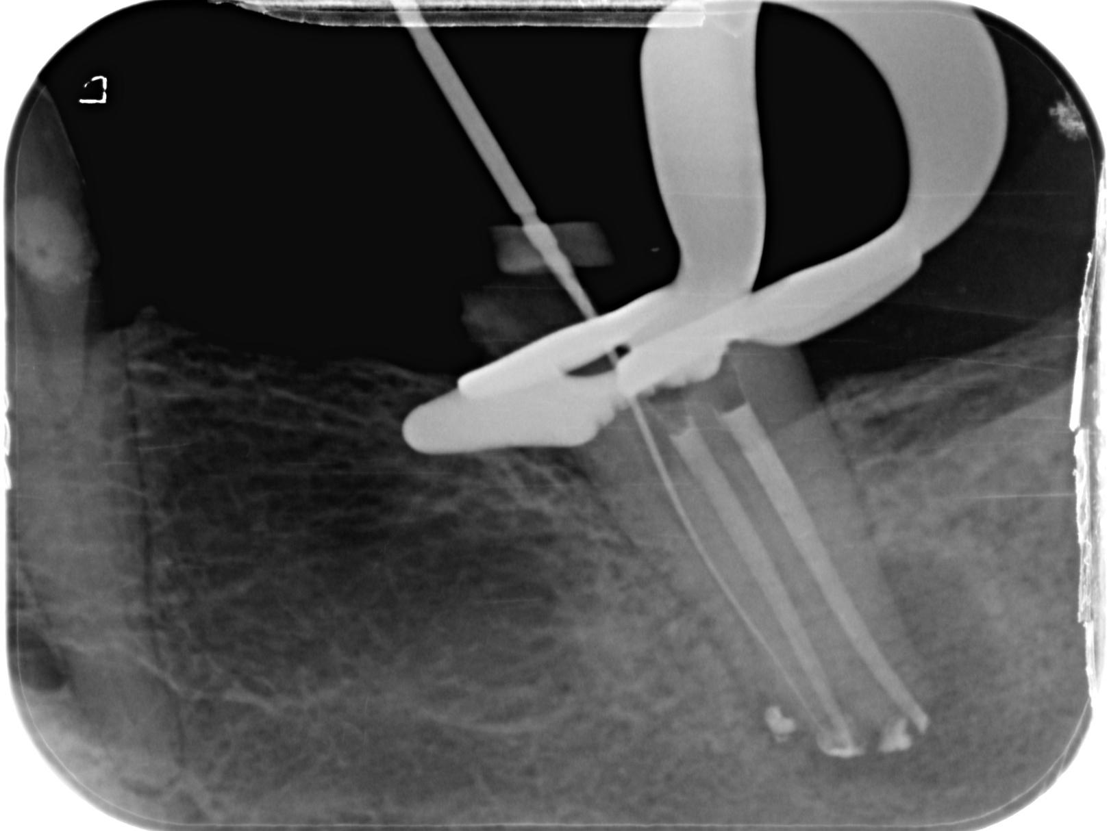 Intra-operative radiograph after broken file removal