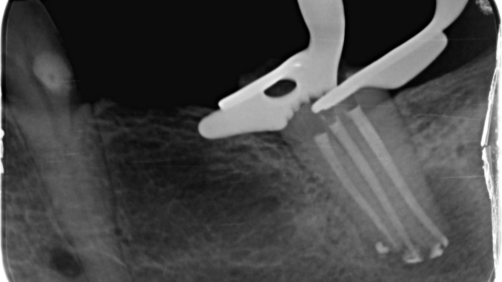 Post-operative radiograph
