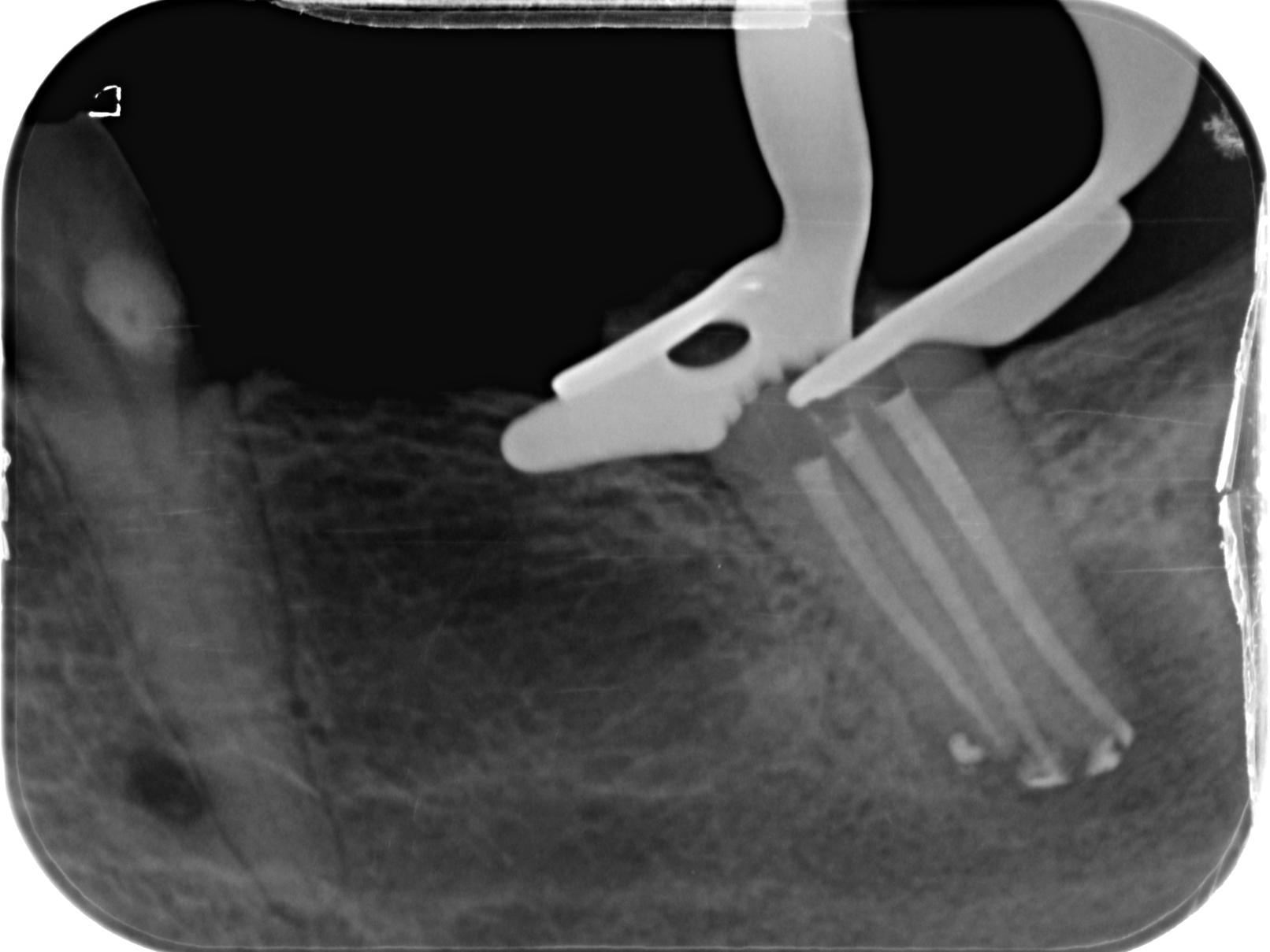Post-operative radiograph