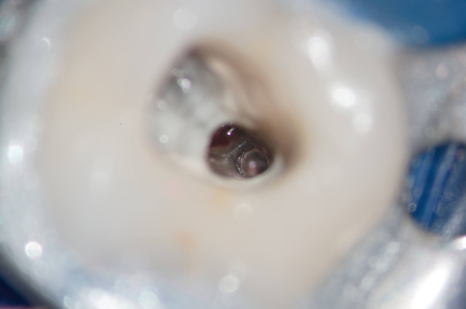 Canal and  perforation after post removal