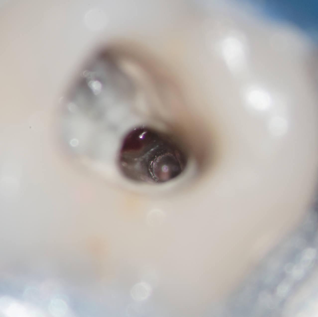 Canal and  perforation after post removal