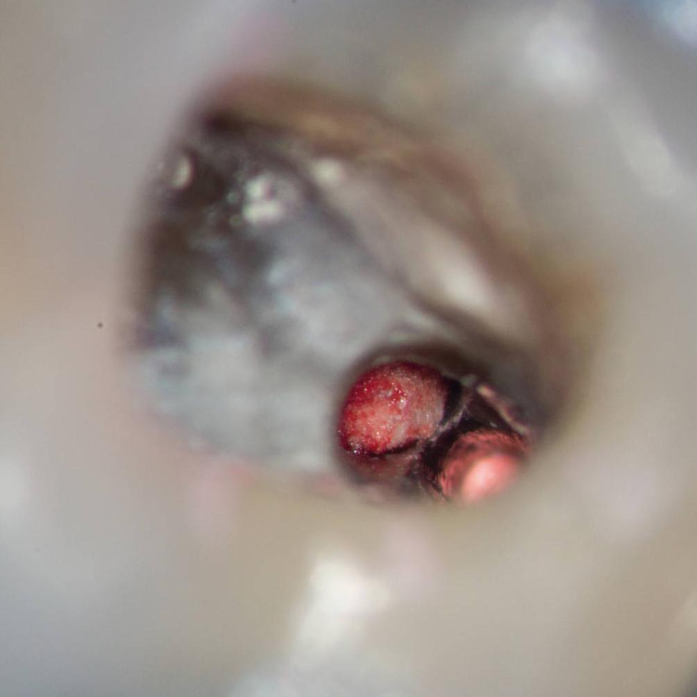 Root filling and collagen matrix