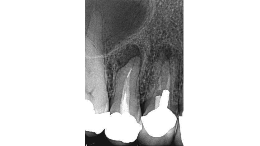 Pre-operative radiograph of upper right first premolar showing metal posts