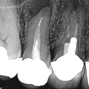 Pre-operative radiograph of upper right first premolar showing metal posts