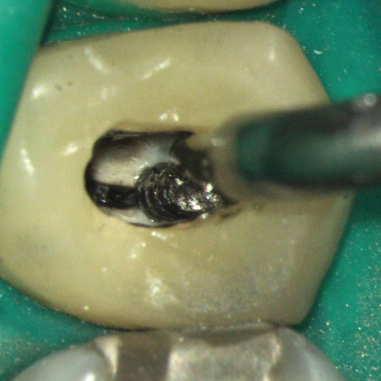Intracoronal removal of the post and core while retaining the crown. The post is being removed with ultrasonics