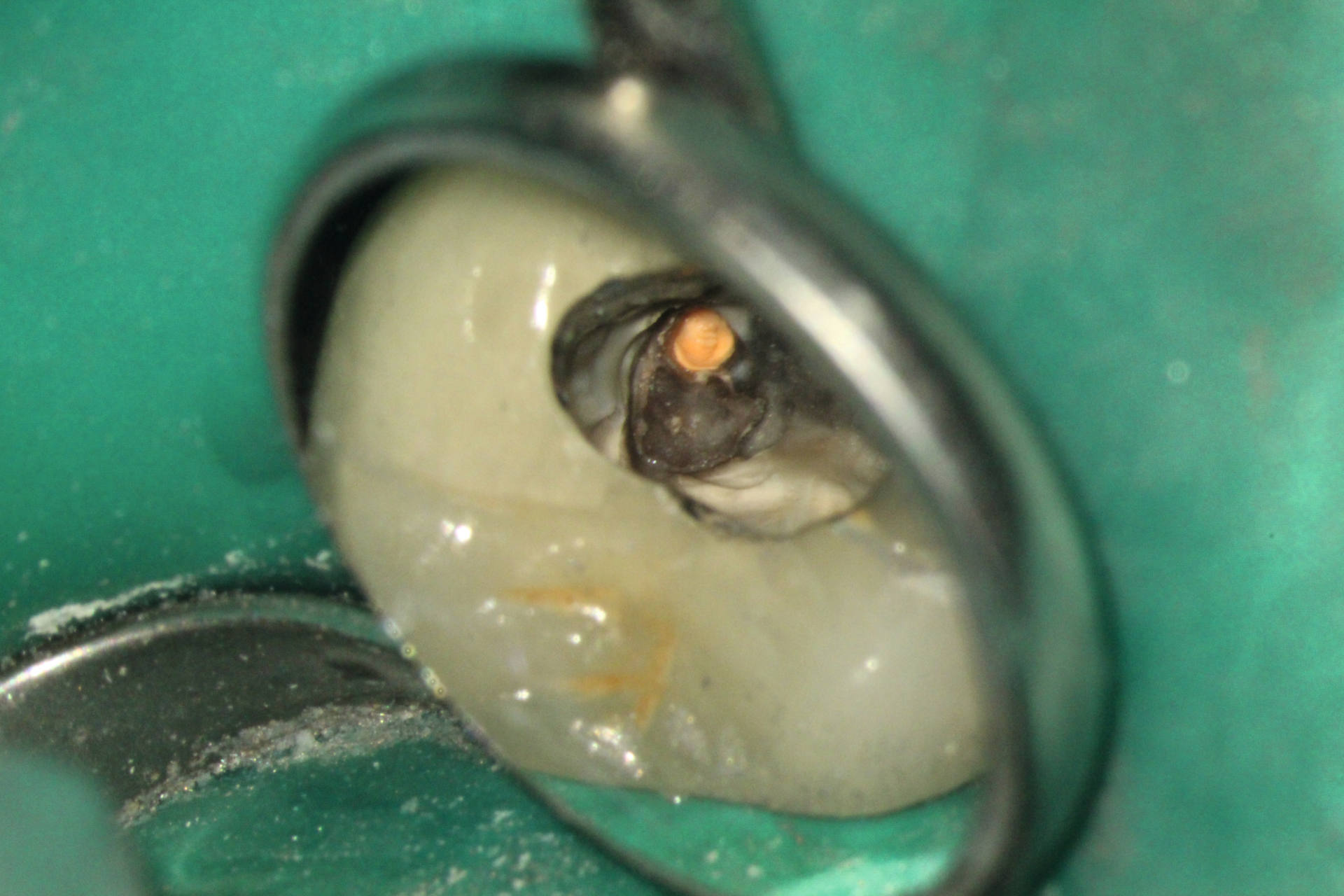 Pulp stone in the palatal canal adjacent to the root filling
