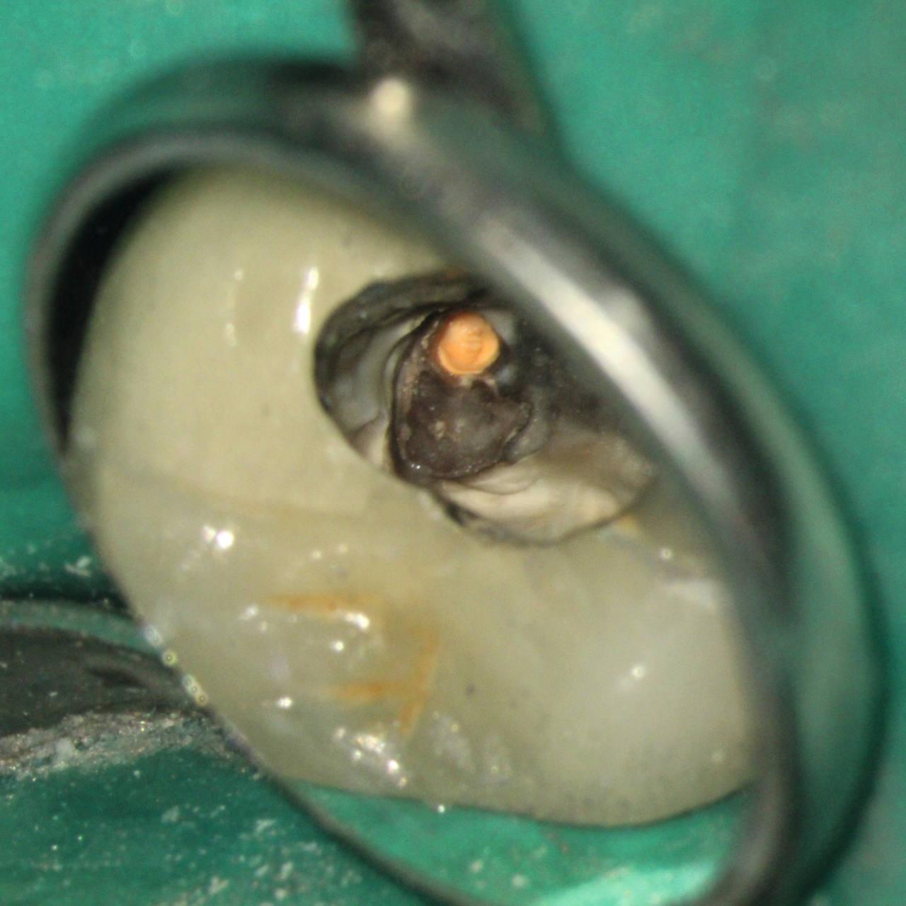 Pulp stone in the palatal canal adjacent to the root filling
