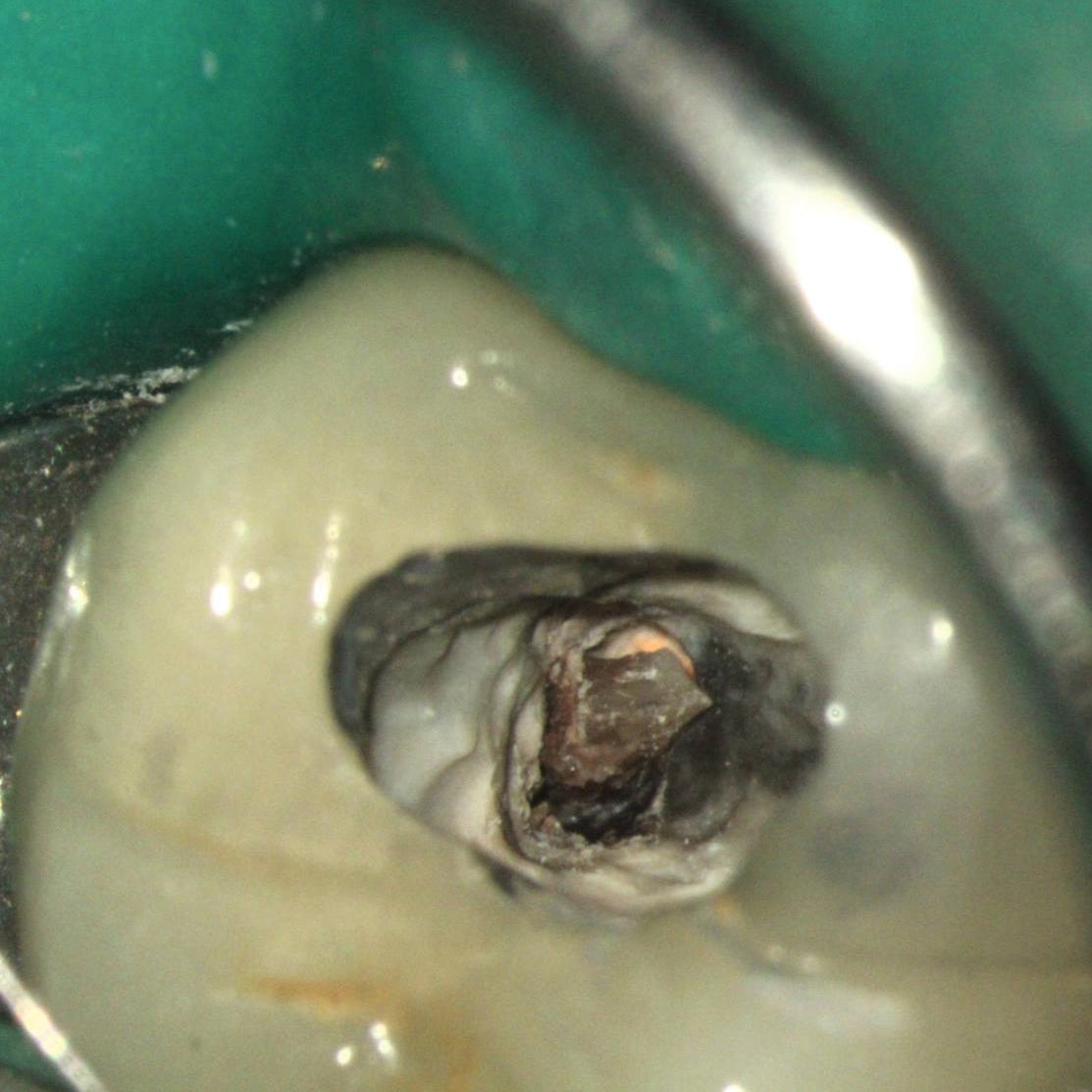 Pulp stone partially removed from canal