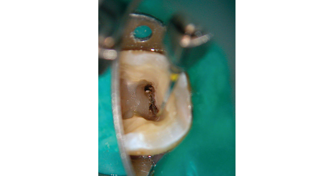 Removal of tissue from the isthmus between the mesial canals of a lower molar using ultrasonically energised K-files