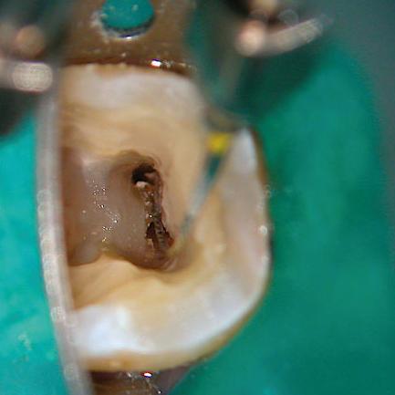 Removal of tissue from the isthmus between the mesial canals of a lower molar using ultrasonically energised K-files
