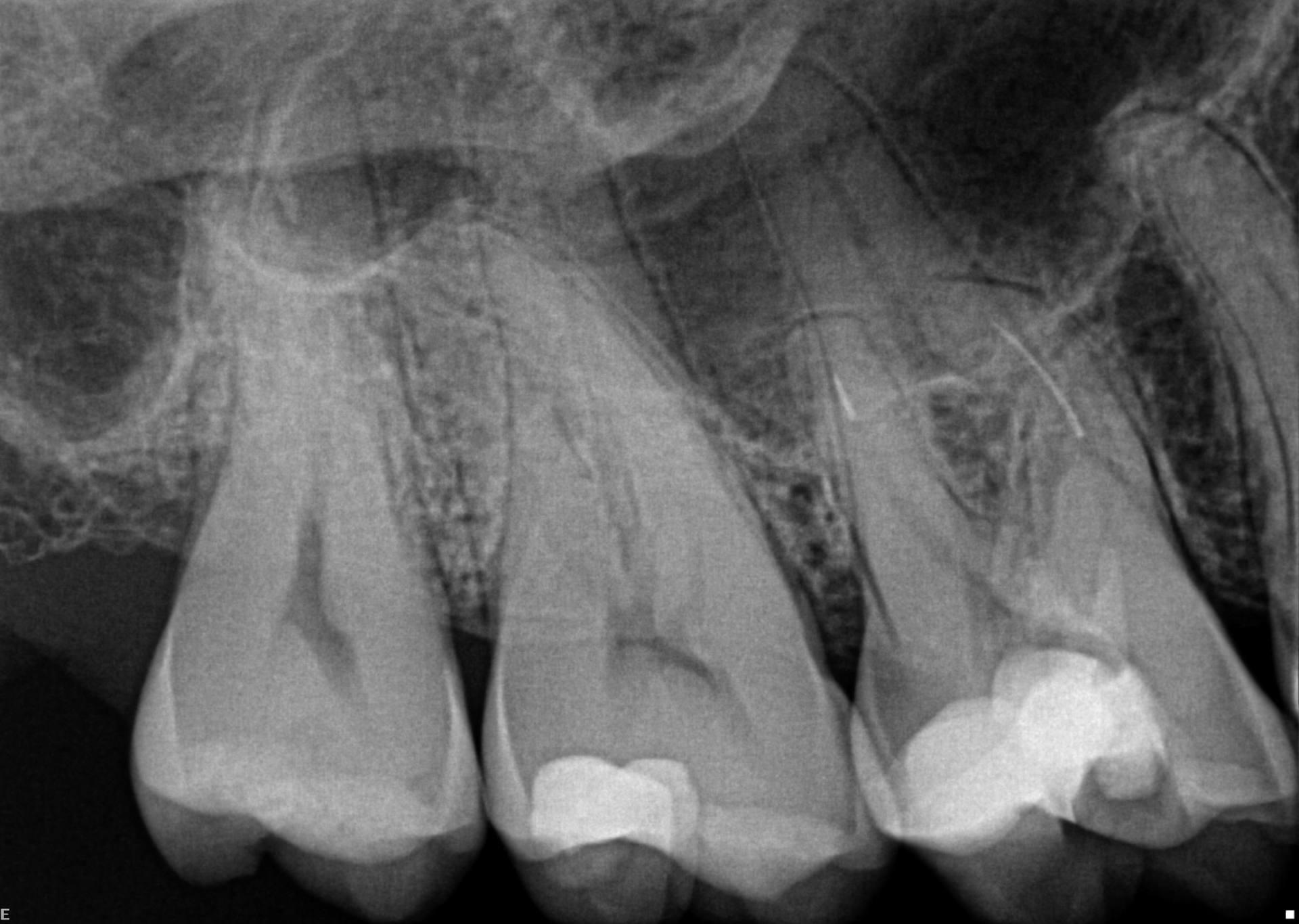 Pre-operative radiograph of upper right first molar tooth with two fractured instruments