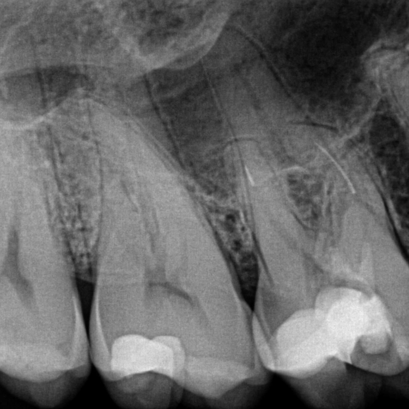 Pre-operative radiograph of upper right first molar tooth with two fractured instruments