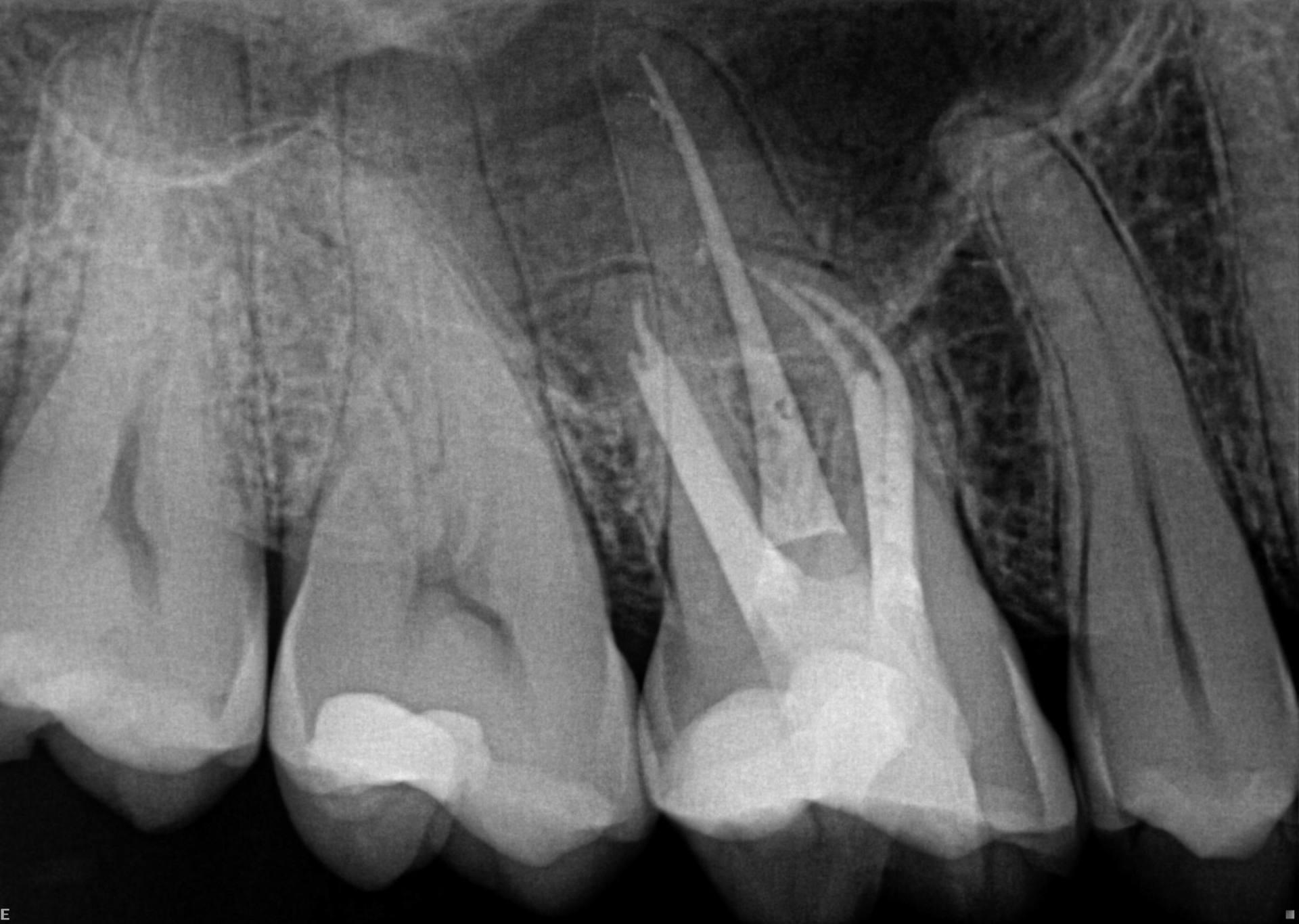 Post-operative radiograph of the same tooth with the instruments removed using ultrasonic instruments controlled under the OPMI. Note that the canals were curved in a bucco-palatal direction.