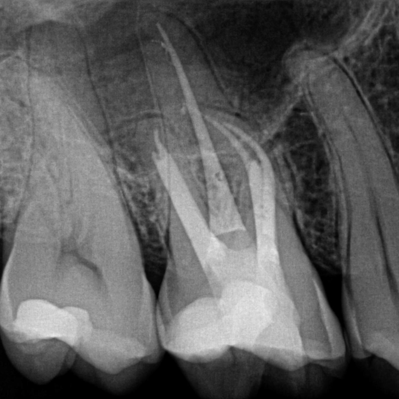 Post-operative radiograph of the same tooth with the instruments removed using ultrasonic instruments controlled under the OPMI. Note that the canals were curved in a bucco-palatal direction.