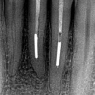 Pre-operative radiograph of two lower incisors with apically placed silver point root fillings