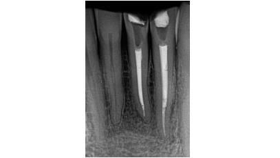 Post-operative radiograph of lower incisors with silver points removed