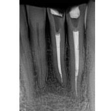 Post-operative radiograph of lower incisors with silver points removed