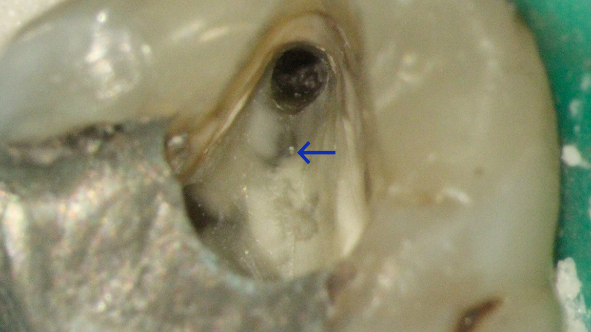 MB2 visible as a white spot, too small for a 0.06 file to enter
