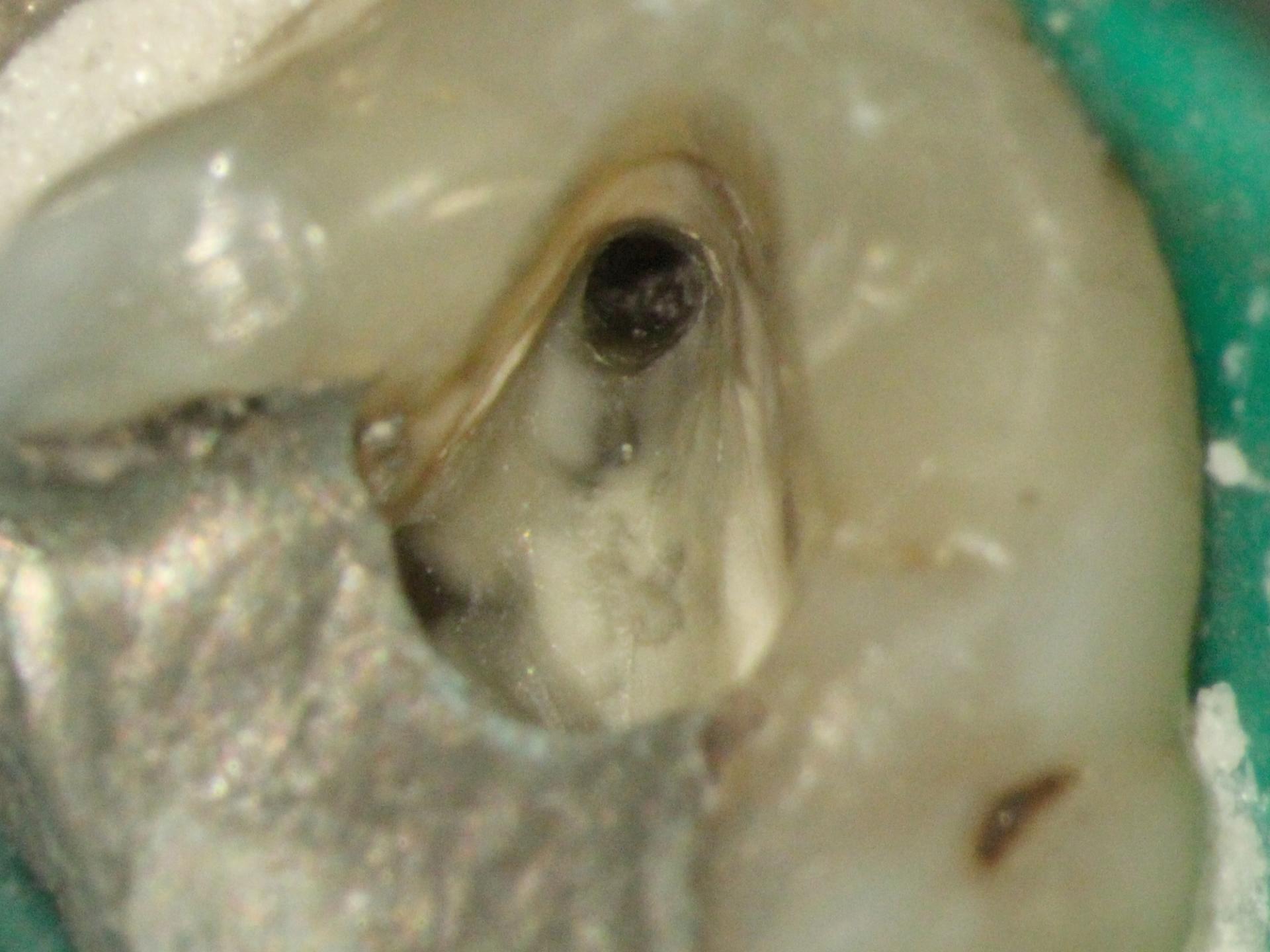 Localizzazione del canale radicolare: una sfida per l’odontoiatria