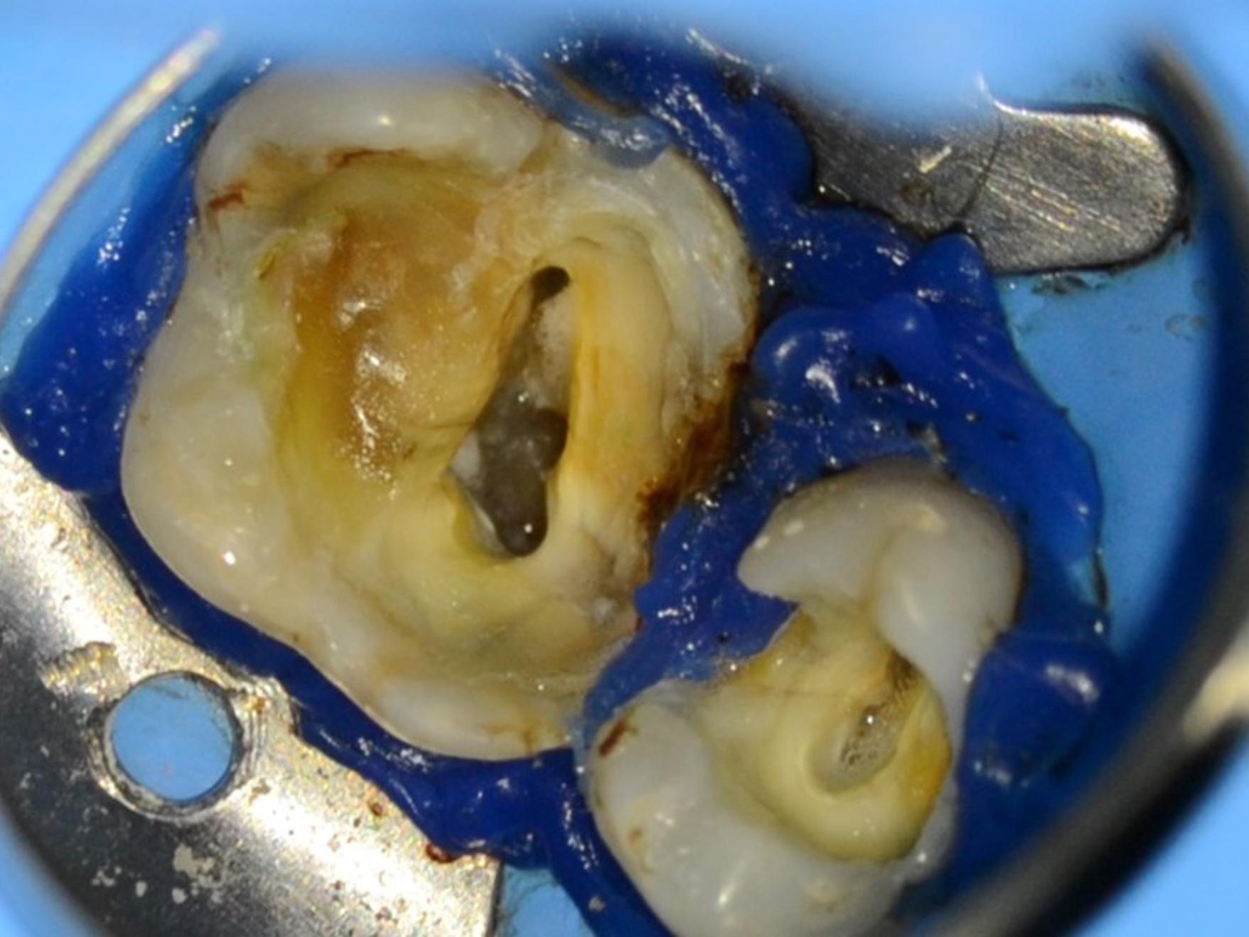 Identificar os 4 canais MB completamente após a remoção da calcificação com uma ampliação de 0,6x.