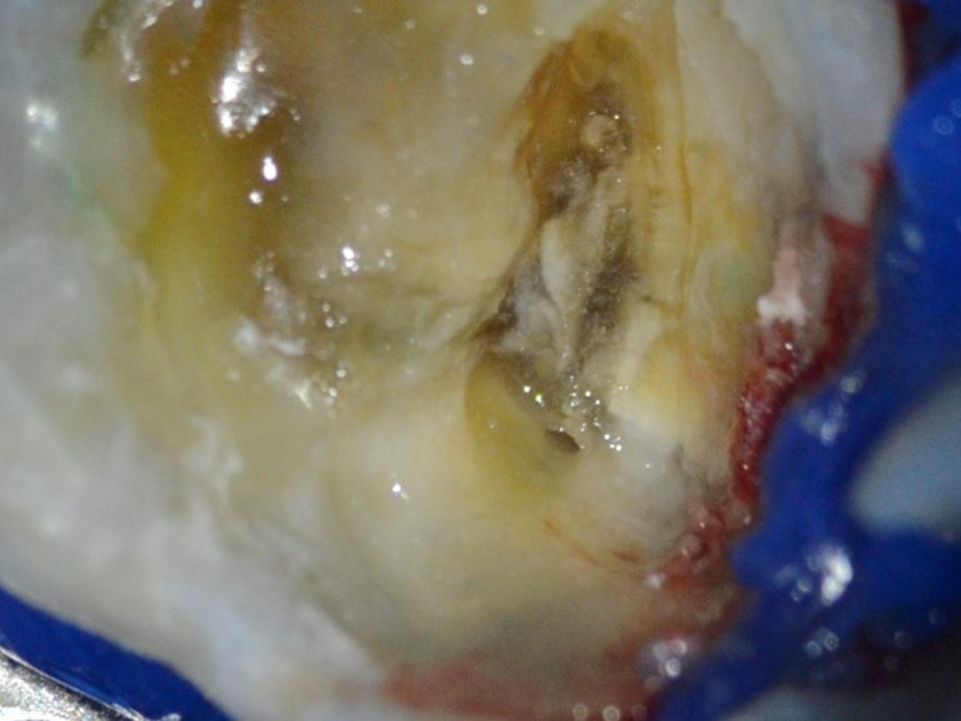 Identification des canaux MB et DB dans la chambre calcifiée à un grossissement de 1,6×.