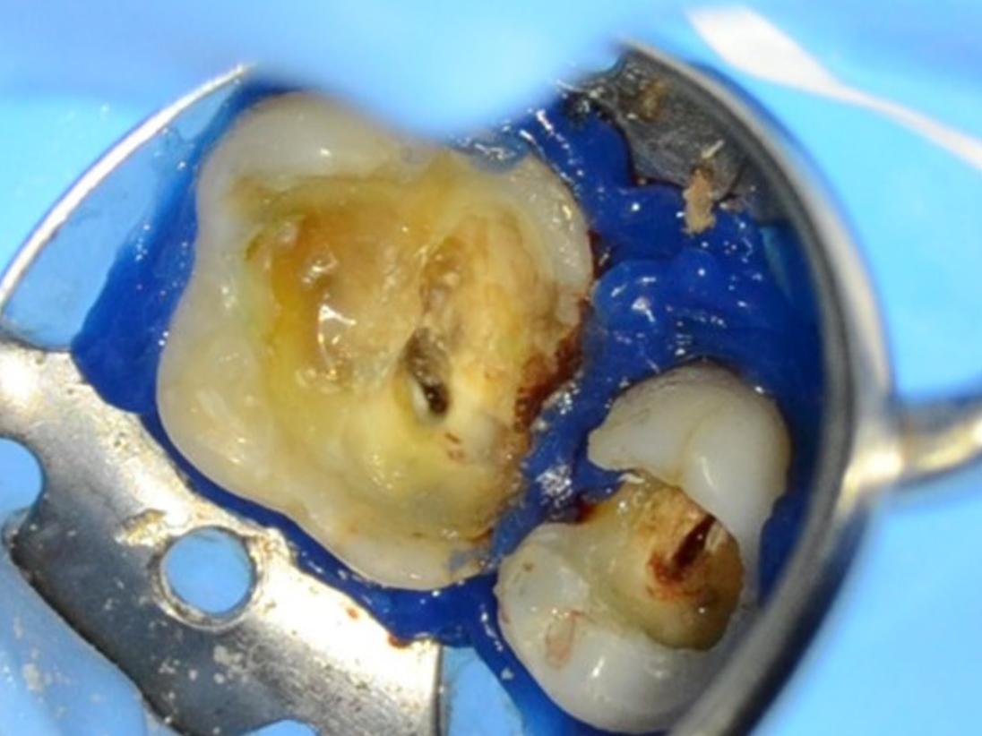 Identification des canaux MB et DB dans la chambre calcifiée à un grossissement de 0,4×.