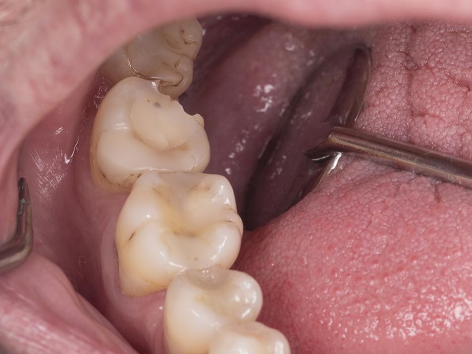 Tooth preparation challenges: Common errors and easier diagnostic 