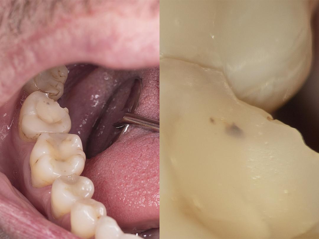 Diagnose ohne Vergrößerung (links) und mit hoher Vergrößerung (rechts)