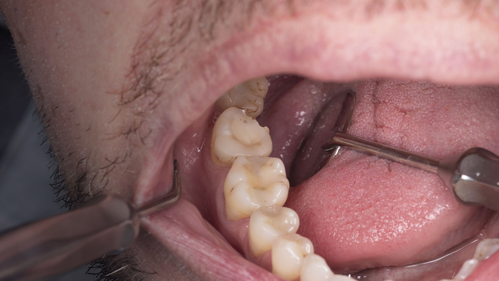 健康・医学 The Tooth Preparation Common errors and easier diagnostic of tooth preparation