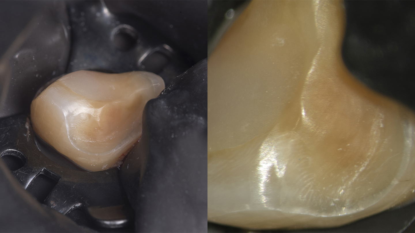 Tooth preparation without magnification (left) and with high magnification (right)