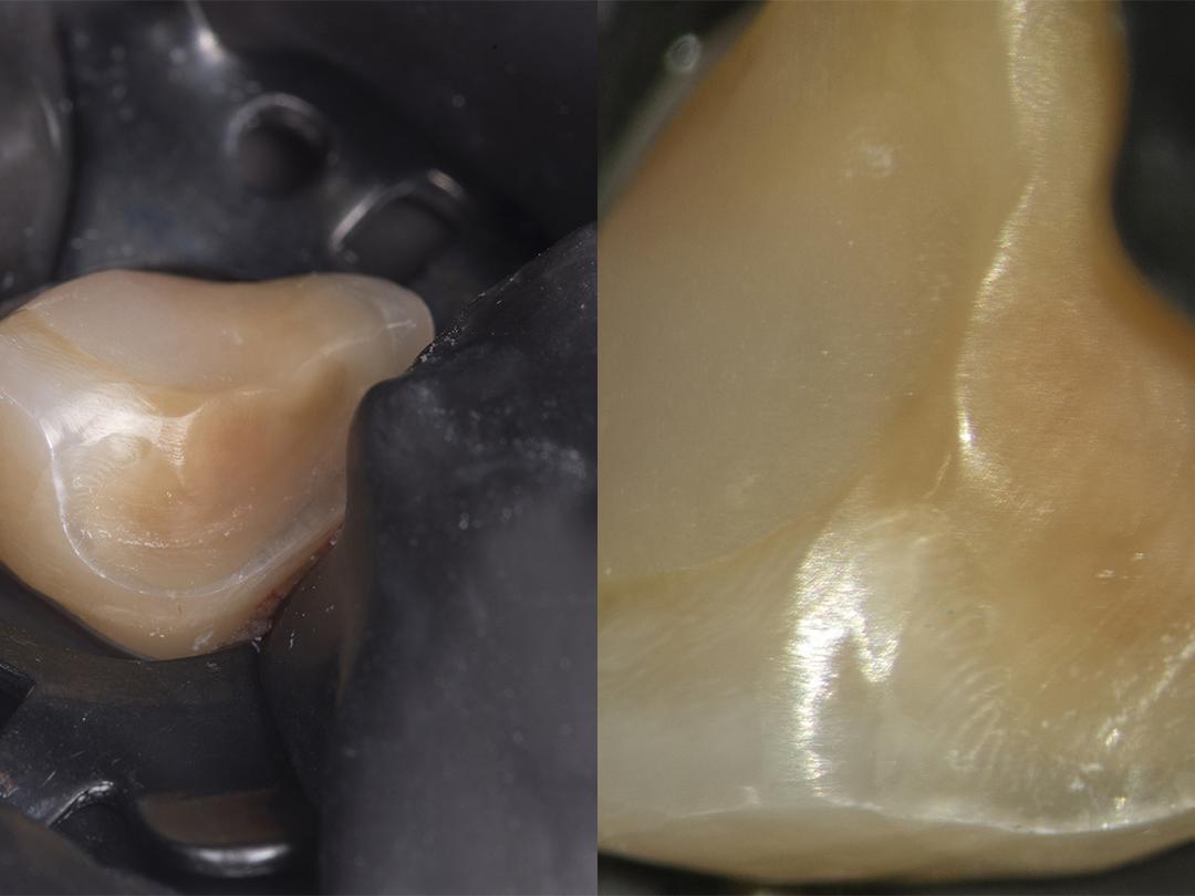 Tooth preparation without magnification (left) and with high magnification (right)