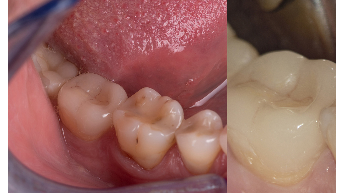 Try-in and cementation without magnification (left) and with high magnification (right)