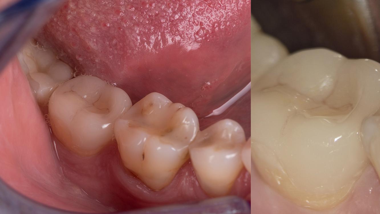 Try-in and cementation without magnification (left) and with high magnification (right)