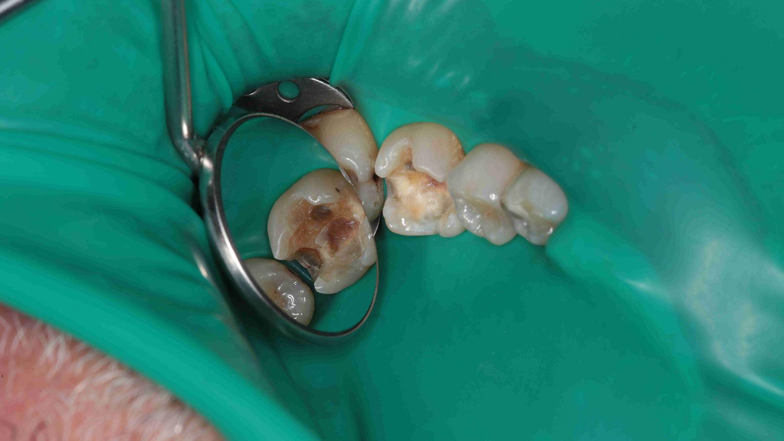 mage of the cavity after first attempt of removing old restoration and caries with the naked eye