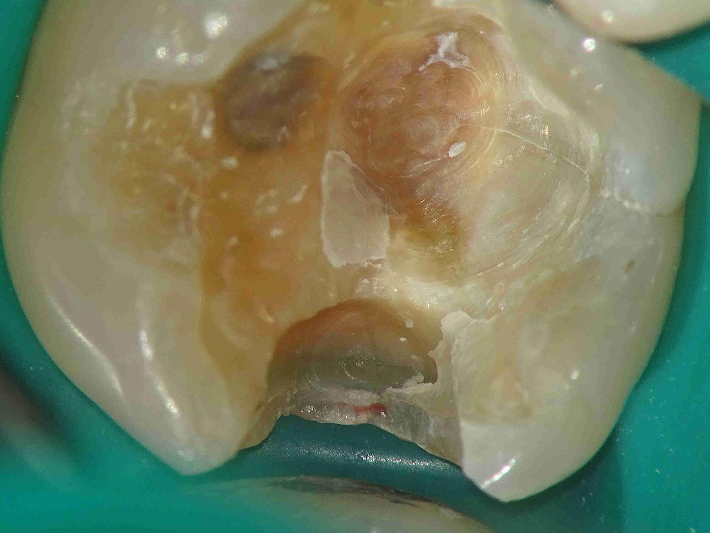 Fig. 2 - Immagine della cavità dopo il primo tentativo di rimozione del vecchio restauro e della carie con ingrandimento 10X