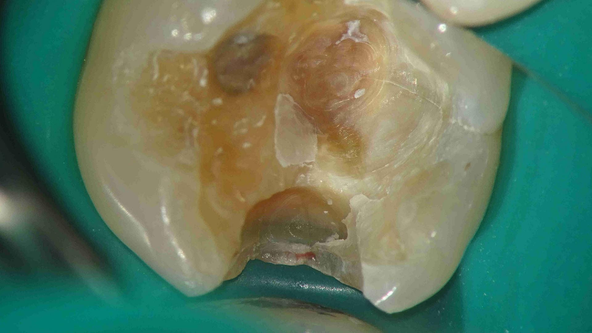 Image of the cavity after first attempt of removing old restoration and caries with 10X magnification.