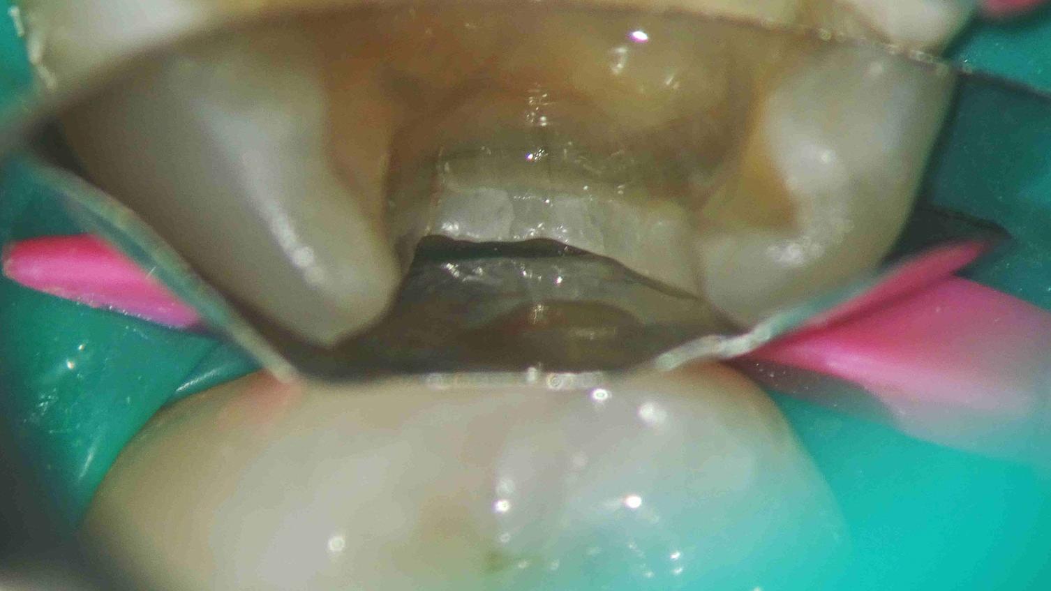 Bild einer sektionalen Matrix, die nicht ordnungsgemäß am Gingivarand platziert wurde. 12-fache Vergrößerung