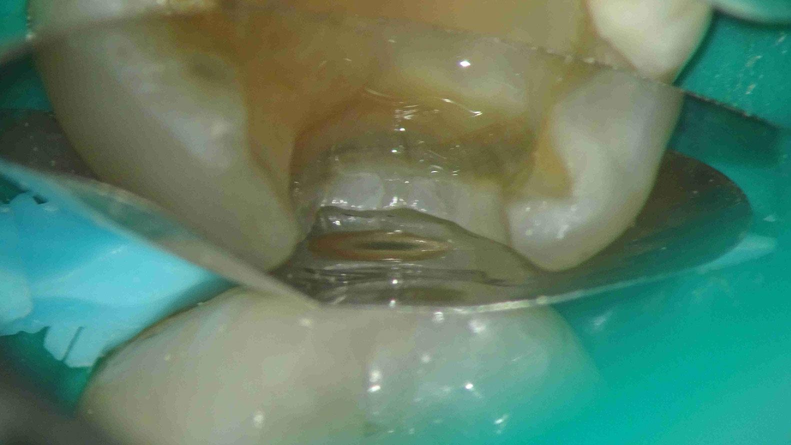 Bild einer sektionalen Matrix, die ordnungsgemäß an den Gingivarand angepasst wurde. 12-fache Vergrößerung