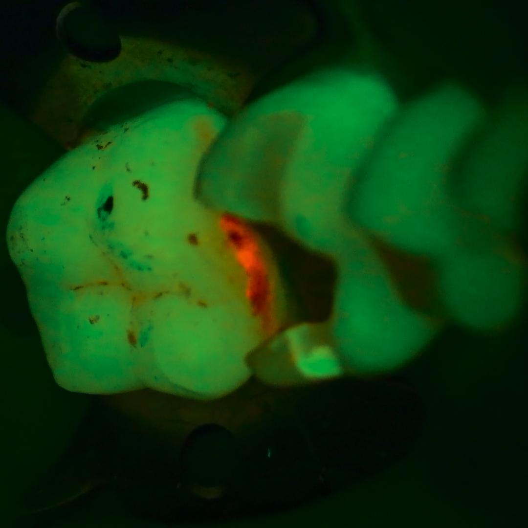 Close-up image of a tooth illuminated under green fluorescence, revealing structural details and a red-highlighted area, viewed through a ZEISS dental microscope.