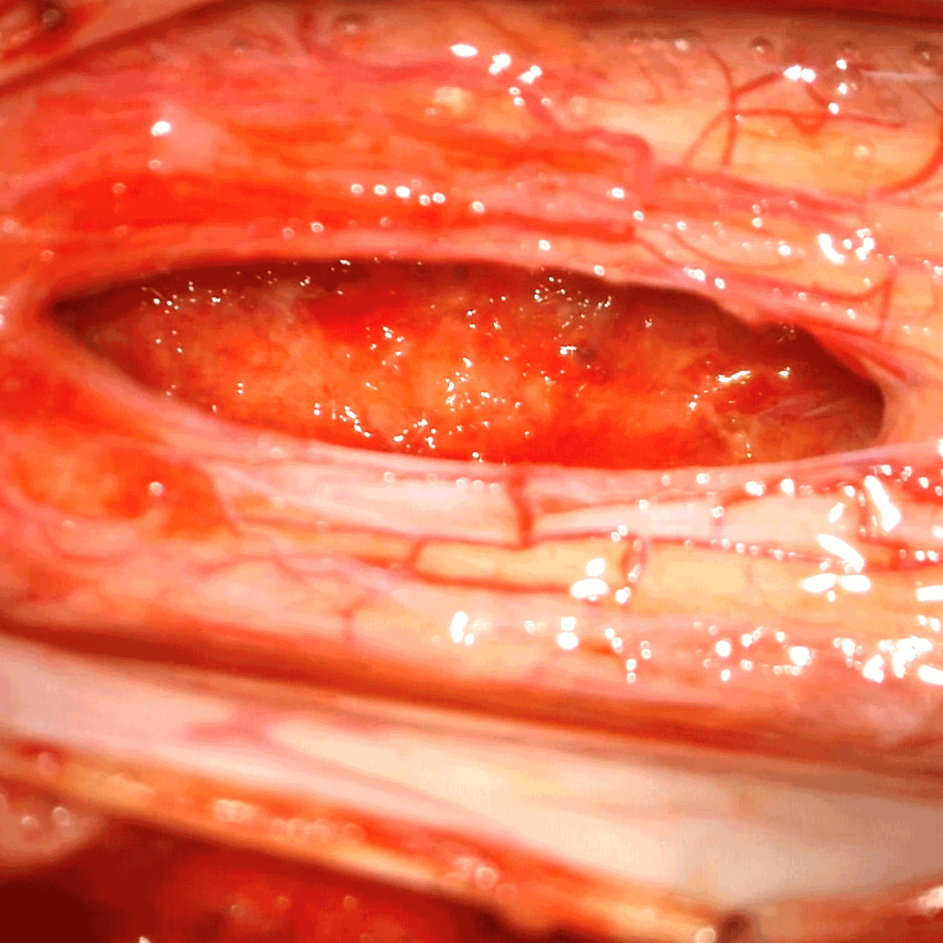 Intramedullary Spinal Cord Tumors