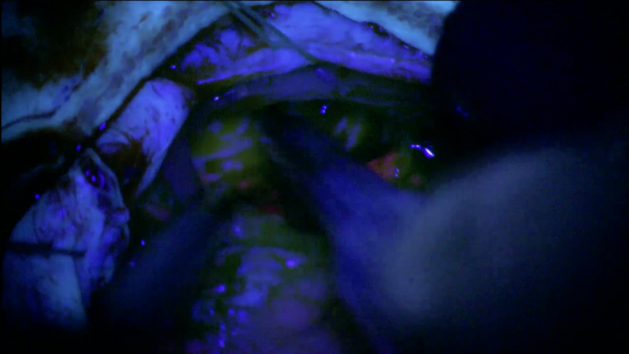 Ressecção de glioma de alto grau guiada por fluorescência com o ZEISS BLUE 400